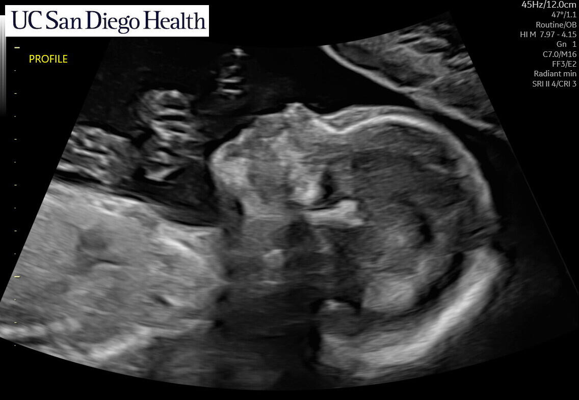 Already sucking his thumb